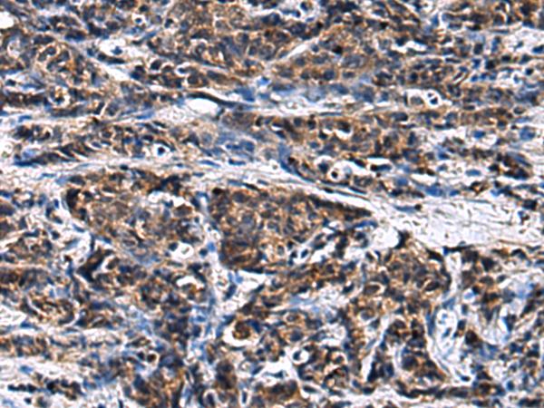 GANAB / Alpha Glucosidase II Antibody - Immunohistochemistry of paraffin-embedded Human prost ate cancer tissue  using GANAB Polyclonal Antibody at dilution of 1:30(×200)