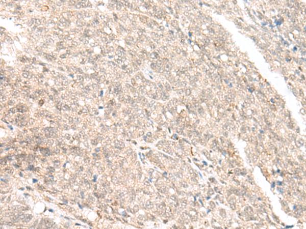 GANC Antibody - Immunohistochemistry of paraffin-embedded Human ovarian cancer tissue  using GANC Polyclonal Antibody at dilution of 1:45(×200)