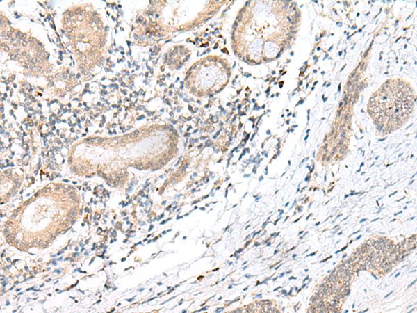 GANC Antibody - Immunohistochemistry of paraffin-embedded Human esophagus cancer tissue  using GANC Polyclonal Antibody at dilution of 1:45(×200)