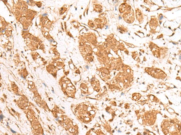 GANC Antibody - Immunohistochemistry of paraffin-embedded Human breast cancer tissue  using GANC Polyclonal Antibody at dilution of 1:55(×200)