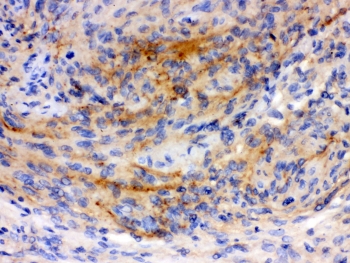 GAP43 Antibody - IHC-P: GAP43 antibody testing of human Menginges tumor tissue