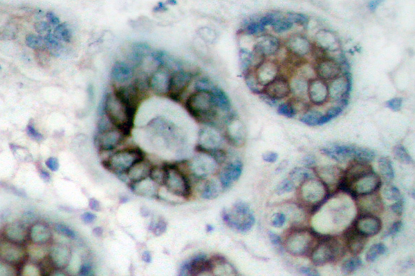 GAP43 Antibody - IHC of GAP43 (A35) pAb in paraffin-embedded human breast carcinoma tissue.