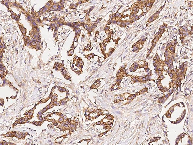 GAP43 Antibody - Immunochemical staining of human GAP43 in human breast carcinoma with rabbit polyclonal antibody at 1:300 dilution, formalin-fixed paraffin embedded sections.