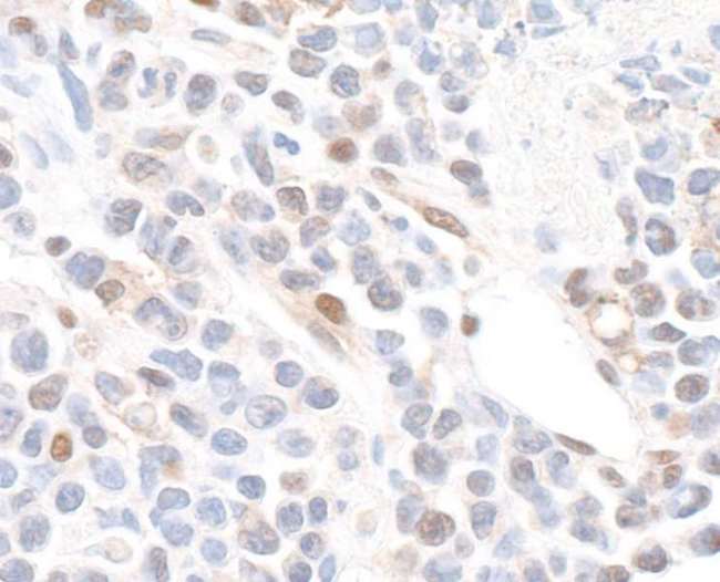 GAPDH Antibody - Detection of mouse GAPDH by immunohistochemistry. Sample: FFPE section of mouse plasmacytoma. Antibody: Affinity purified rabbit anti-GAPDH used at a dilution of 1:1,000 (0.2µg/ml). Detection: DAB