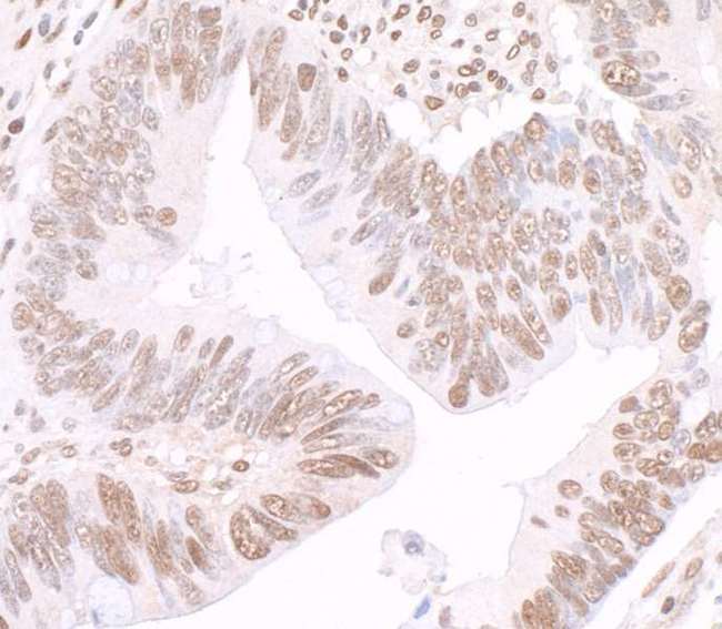 GAPDH Antibody - Detection of human GAPDH by immunohistochemistry. Sample: FFPE section of human colon carcinoma. Antibody: Affinity purified rabbit anti-GAPDH used at a dilution of 1:1,000 (0.2µg/ml). Detection: DAB