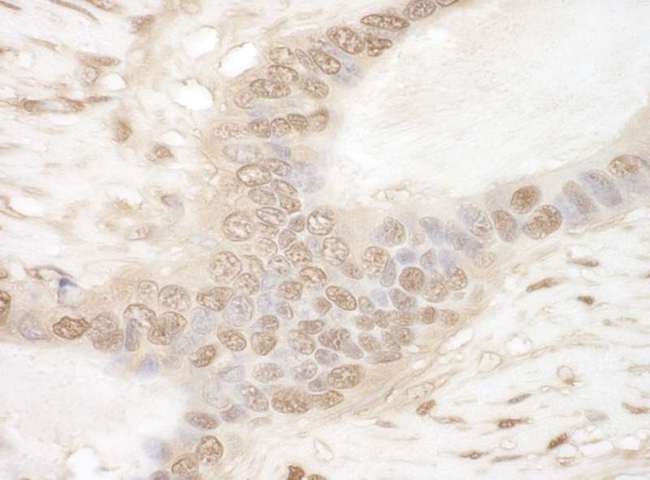 GAPDH Antibody - Detection of Human GAPDH by Immunohistochemistry. Sample: FFPE section of human ovarian carcinoma. Antibody: monoclonal anti-GAPDH antibody used at a dilution of 1:200.