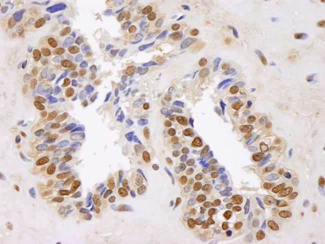 GAPDH Antibody - Detection of Human GAPDH by Immunohistochemistry. Sample: FFPE section of human prostate adenocarcinoma. Antibody: Affinity purified rabbit anti-GAPDH used at a dilution of 1:250. Detection: DAB staining using anti-Rabbit IHC antibody at a dilution of 1:100.
