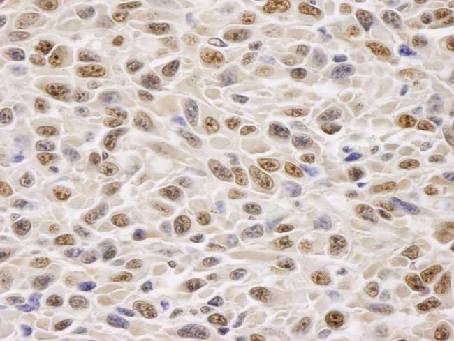 GAPDH Antibody - Detection of Mouse GAPDH by Immunohistochemistry. Sample: FFPE section of mouse squamous cell carcinoma. Antibody: Affinity purified rabbit anti-GAPDH used at a dilution of 1:250. Detection: DAB staining using anti-Rabbit IHC antibody at a dilution of 1:100.