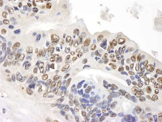 GAPDH Antibody - Detection of Human GAPDH by Immunohistochemistry. Sample: FFPE section of human ovarian carcinoma. Antibody: Affinity purified rabbit anti-GAPDH used at a dilution of 1:500. Detection: DAB staining using anti-Rabbit IHC antibody at a dilution of 1:100.