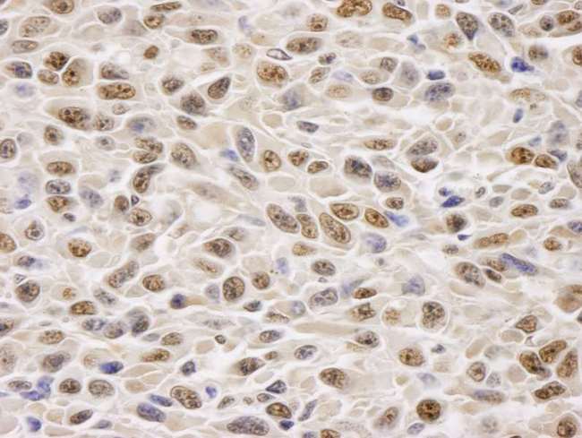 GAPDH Antibody - Detection of Mouse GAPDH by Immunohistochemistry. Sample: FFPE section of mouse squamous cell carcinoma. Antibody: Affinity purified rabbit anti-GAPDH used at a dilution of 1:100. Detection: DAB staining using anti-Rabbit IHC antibody at a dilution of 1:100.