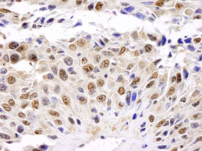 GAPDH Antibody - Detection of Mouse GAPDH by Immunohistochemistry. Sample: FFPE section of mouse squamous cell carcinoma. Antibody: Affinity purified rabbit anti-GAPDH used at a dilution of 1:200 (1 Detection: DAB.