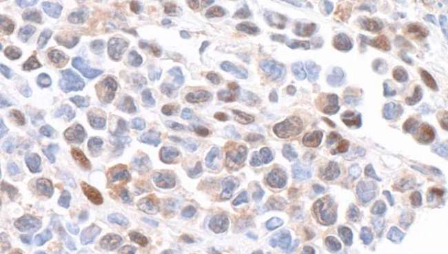GAPDH Antibody - Detection of mouse GAPDH by immunohistochemistry. Sample: FFPE section of mouse plasmacytoma. Antibody: Affinity purified rabbit anti-GAPDH used at a dilution of 1:1000 (0.2µg/ml). Detection: DAB