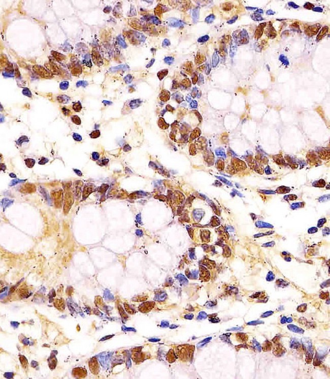 GAPDH Antibody - GAPDH Antibody staining GAPDH in human colon tissue sections by Immunohistochemistry (IHC-P - paraformaldehyde-fixed, paraffin-embedded sections). Tissue was fixed with formaldehyde and blocked with 3% BSA for 0. 5 hour at room temperature; antigen retrieval was by heat mediation with a citrate buffer (pH6). Samples were incubated with primary antibody (1/25) for 1 hours at 37°C. A undiluted biotinylated goat polyvalent antibody was used as the secondary antibody.