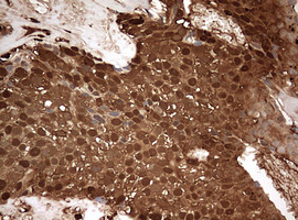 GAPDH Antibody - IHC of paraffin-embedded Adenocarcinoma of Human breast tissue using anti-GAPDH mouse monoclonal antibody. (Heat-induced epitope retrieval by 10mM citric buffer, pH6.0, 120°C for 3min).