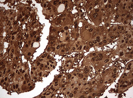 GAPDH Antibody - IHC of paraffin-embedded Carcinoma of Human liver tissue using anti-GAPDH mouse monoclonal antibody. (Heat-induced epitope retrieval by 10mM citric buffer, pH6.0, 120°C for 3min).