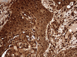 GAPDH Antibody - IHC of paraffin-embedded Carcinoma of Human lung tissue using anti-GAPDH mouse monoclonal antibody. (Heat-induced epitope retrieval by 10mM citric buffer, pH6.0, 120°C for 3min).