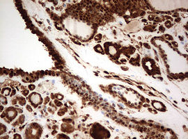 GAPDH Antibody - IHC of paraffin-embedded Carcinoma of Human thyroid tissue using anti-GAPDH mouse monoclonal antibody. (Heat-induced epitope retrieval by 10mM citric buffer, pH6.0, 120°C for 3min).
