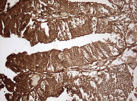 GAPDH Antibody - IHC of paraffin-embedded Adenocarcinoma of Human endometrium tissue using anti-GAPDH mouse monoclonal antibody. (Heat-induced epitope retrieval by 10mM citric buffer, pH6.0, 120°C for 3min).