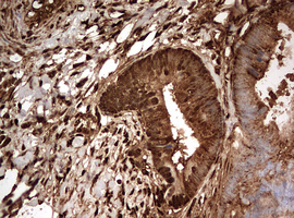 GAPDH Antibody - IHC of paraffin-embedded Adenocarcinoma of Human colon tissue using anti-GAPDH mouse monoclonal antibody. (Heat-induced epitope retrieval by 10mM citric buffer, pH6.0, 120°C for 3min).