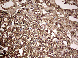 GAPDH Antibody - IHC of paraffin-embedded Carcinoma of Human kidney tissue using anti-GAPDH mouse monoclonal antibody. (Heat-induced epitope retrieval by 10mM citric buffer, pH6.0, 120°C for 3min).