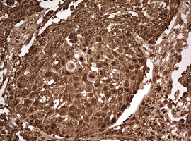 GAPDH Antibody - IHC of paraffin-embedded Carcinoma of Human lung tissue using anti-GAPDH mouse monoclonal antibody. (Heat-induced epitope retrieval by 10mM citric buffer, pH6.0, 120°C for 3min).