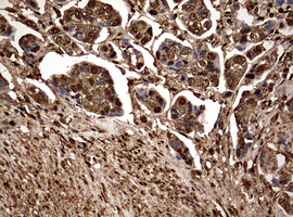 GAPDH Antibody - IHC of paraffin-embedded Carcinoma of Human bladder tissue using anti-GAPDH mouse monoclonal antibody. (Heat-induced epitope retrieval by 10mM citric buffer, pH6.0, 120°C for 3min).
