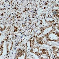 GAPDH Antibody - Immunohistochemical analysis of GAPDH staining in human breast cancer formalin fixed paraffin embedded tissue section. The section was pre-treated using heat mediated antigen retrieval with sodium citrate buffer (pH 6.0). The section was then incubated with the antibody at room temperature and detected using an HRP conjugated compact polymer system. DAB was used as the chromogen. The section was then counterstained with hematoxylin and mounted with DPX.