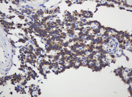 GAPDHS / GAPDS Antibody - IHC of paraffin-embedded Carcinoma of Human pancreas tissue using anti-GAPDHS mouse monoclonal antibody.