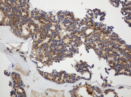 GAPDHS / GAPDS Antibody - IHC of paraffin-embedded Carcinoma of Human thyroid tissue using anti-GAPDHS mouse monoclonal antibody.