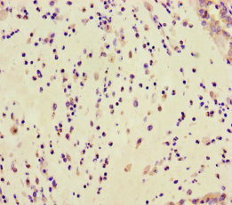 GAR1 / NOLA1 Antibody - Immunohistochemistry of paraffin-embedded human lung cancer using GAR1 Antibody at dilution of 1:100