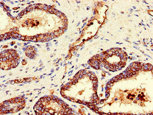 GAREM / FAM59A Antibody - Immunohistochemistry of paraffin-embedded human prostate cancer using GAREM1 Antibody at dilution of 1:100