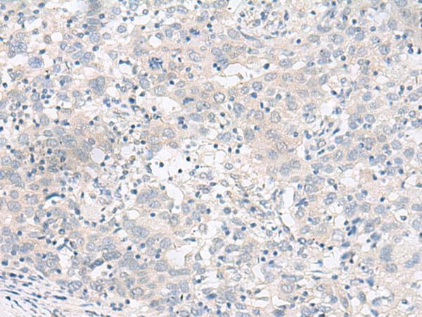 GARNL1 / RALGAPA1 Antibody - Immunohistochemistry of paraffin-embedded Human cervical cancer tissue  using RALGAPA1 Polyclonal Antibody at dilution of 1:55(×200)