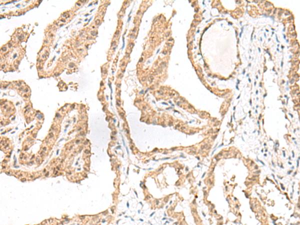 GARNL1 / RALGAPA1 Antibody - Immunohistochemistry of paraffin-embedded Human thyroid cancer tissue  using RALGAPA1 Polyclonal Antibody at dilution of 1:55(×200)