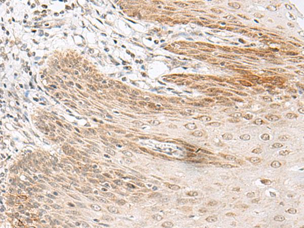 GARNL1 / RALGAPA1 Antibody - Immunohistochemistry of paraffin-embedded Human esophagus cancer tissue  using RALGAPA1 Polyclonal Antibody at dilution of 1:55(×200)
