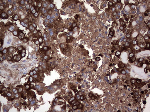 GARS / Glycyl tRNA Synthetase Antibody - Immunohistochemical staining of paraffin-embedded Adenocarcinoma of Human ovary tissue using anti-GARS mouse monoclonal antibody. (Heat-induced epitope retrieval by 1 mM EDTA in 10mM Tris, pH8.5, 120C for 3min,