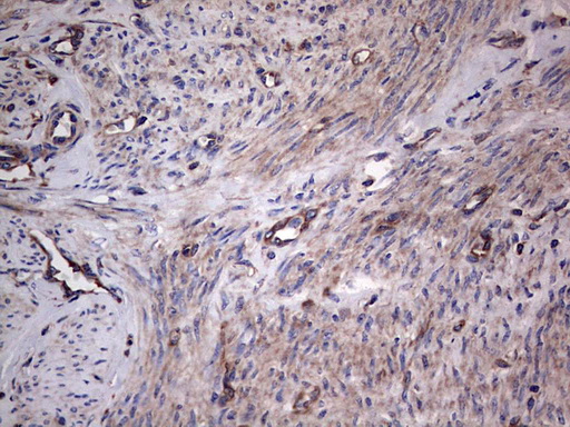 GARS / Glycyl tRNA Synthetase Antibody - Immunohistochemical staining of paraffin-embedded Adenocarcinoma of Human endometrium tissue using anti-GARS mouse monoclonal antibody. (Heat-induced epitope retrieval by 1 mM EDTA in 10mM Tris, pH8.5, 120C for 3min,