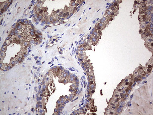 GARS / Glycyl tRNA Synthetase Antibody - Immunohistochemical staining of paraffin-embedded Human prostate tissue within the normal limits using anti-GARS mouse monoclonal antibody. (Heat-induced epitope retrieval by 1 mM EDTA in 10mM Tris, pH8.5, 120C for 3min,