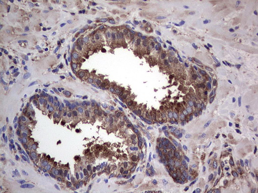 GARS / Glycyl tRNA Synthetase Antibody - Immunohistochemical staining of paraffin-embedded Carcinoma of Human prostate tissue using anti-GARS mouse monoclonal antibody. (Heat-induced epitope retrieval by 1 mM EDTA in 10mM Tris, pH8.5, 120C for 3min,