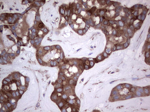 GARS / Glycyl tRNA Synthetase Antibody - Immunohistochemical staining of paraffin-embedded Carcinoma of Human liver tissue using anti-GARS mouse monoclonal antibody. (Heat-induced epitope retrieval by 1 mM EDTA in 10mM Tris, pH8.5, 120C for 3min,