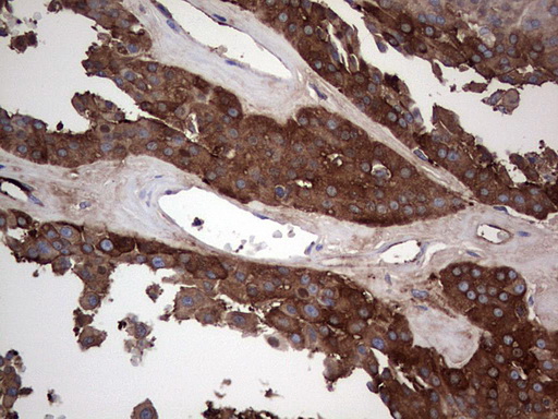 GARS / Glycyl tRNA Synthetase Antibody - IHC of paraffin-embedded Carcinoma of Human thyroid tissue using anti-GARS mouse monoclonal antibody. (Heat-induced epitope retrieval by 1 mM EDTA in 10mM Tris, pH8.5, 120°C for 3min).