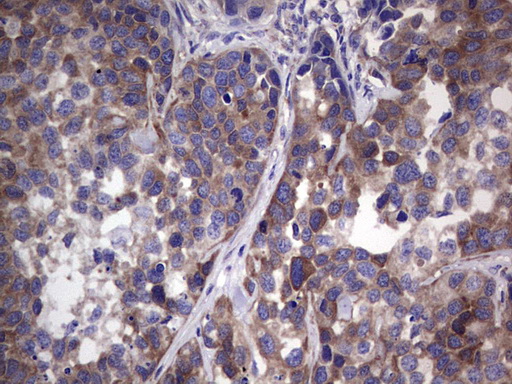 GARS / Glycyl tRNA Synthetase Antibody - Immunohistochemical staining of paraffin-embedded Carcinoma of Human kidney tissue using anti-GARS mouse monoclonal antibody. (Heat-induced epitope retrieval by 1 mM EDTA in 10mM Tris, pH8.5, 120C for 3min,