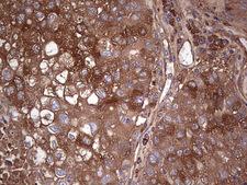 GARS / Glycyl tRNA Synthetase Antibody - Immunohistochemical staining of paraffin-embedded Carcinoma of Human lung tissue using anti-GARS mouse monoclonal antibody. (Heat-induced epitope retrieval by 1 mM EDTA in 10mM Tris, pH8.5, 120C for 3min,