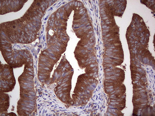 GARS / Glycyl tRNA Synthetase Antibody - Immunohistochemical staining of paraffin-embedded Adenocarcinoma of Human colon tissue using anti-GARS mouse monoclonal antibody. (Heat-induced epitope retrieval by 1 mM EDTA in 10mM Tris, pH8.5, 120C for 3min,