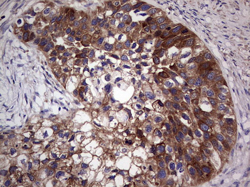 GARS / Glycyl tRNA Synthetase Antibody - IHC of paraffin-embedded Carcinoma of Human kidney tissue using anti-GARS mouse monoclonal antibody. (Heat-induced epitope retrieval by 1 mM EDTA in 10mM Tris, pH8.5, 120°C for 3min).
