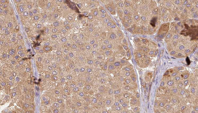 GARS / Glycyl tRNA Synthetase Antibody - 1:100 staining human Melanoma tissue by IHC-P. The sample was formaldehyde fixed and a heat mediated antigen retrieval step in citrate buffer was performed. The sample was then blocked and incubated with the antibody for 1.5 hours at 22°C. An HRP conjugated goat anti-rabbit antibody was used as the secondary.