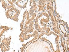 GART / GARS Antibody - Immunohistochemistry of paraffin-embedded Human thyroid cancer tissue  using GART Polyclonal Antibody at dilution of 1:30(×200)