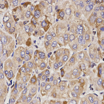GAS2 Antibody - Immunohistochemistry of paraffin-embedded human liver cancer using GAS2 antibodyat dilution of 1:200 (40x lens).