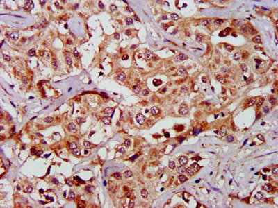 GAS2 Antibody - IHC image of GAS2 Antibody diluted at 1:1000 and staining in paraffin-embedded human liver cancer performed on a Leica BondTM system. After dewaxing and hydration, antigen retrieval was mediated by high pressure in a citrate buffer (pH 6.0). Section was blocked with 10% normal goat serum 30min at RT. Then primary antibody (1% BSA) was incubated at 4°C overnight. The primary is detected by a biotinylated secondary antibody and visualized using an HRP conjugated SP system.