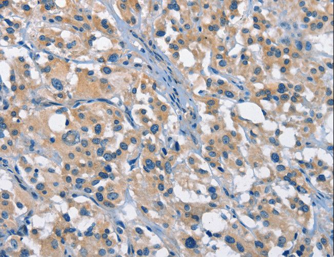 GAS2 Antibody - Immunohistochemistry of paraffin-embedded Human gastric cancer using GAS2 Polyclonal Antibody at dilution of 1:50.