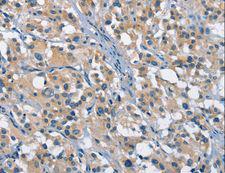 GAS2 Antibody - Immunohistochemistry of paraffin-embedded Human gastric cancer using GAS2 Polyclonal Antibody at dilution of 1:50.